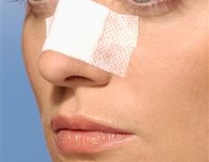 RINOPLASTIA